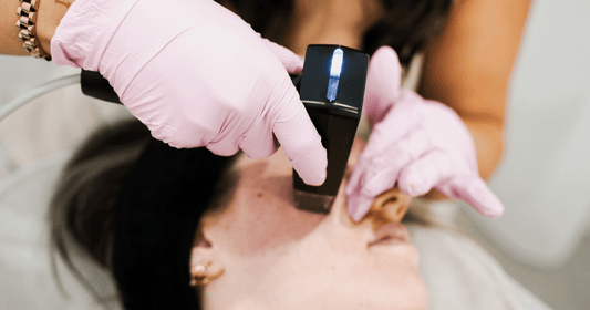 Microneedling Treatment with Morpheus8 in Essendon, Melbourne