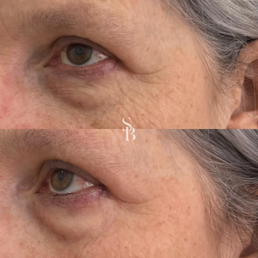 Morpheus8 Microneedling Melbourne – RF Skin Rejuvenation Support