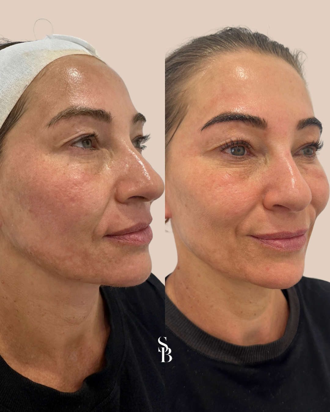 Face Before and After Skin needling with exosomes