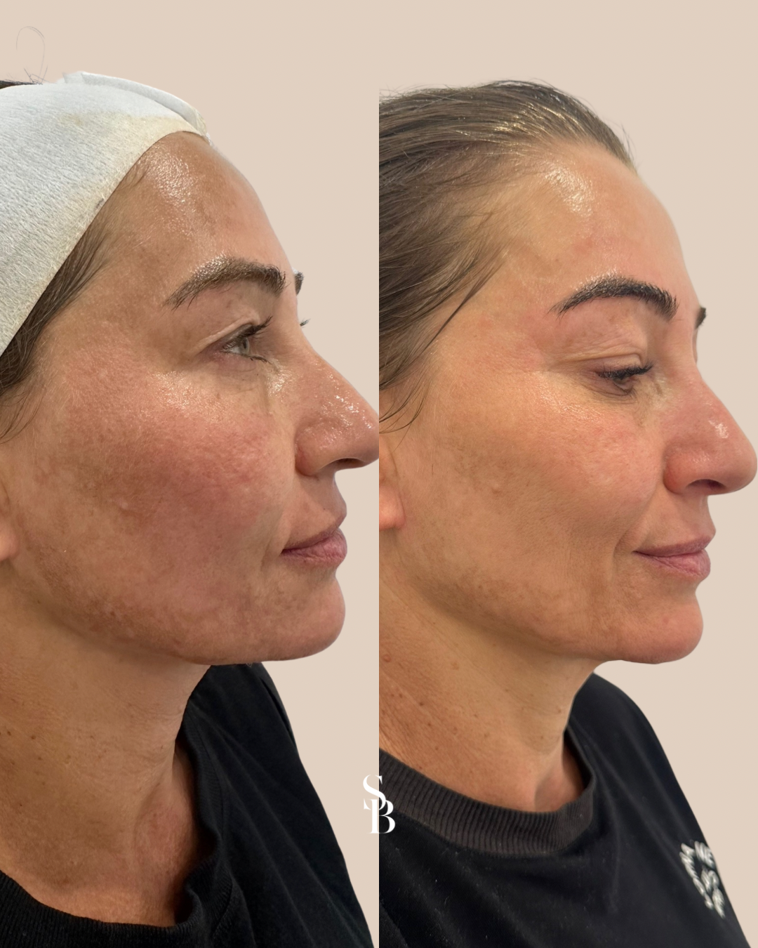 Face Before and After Skin needling with exosomes in Melbourne