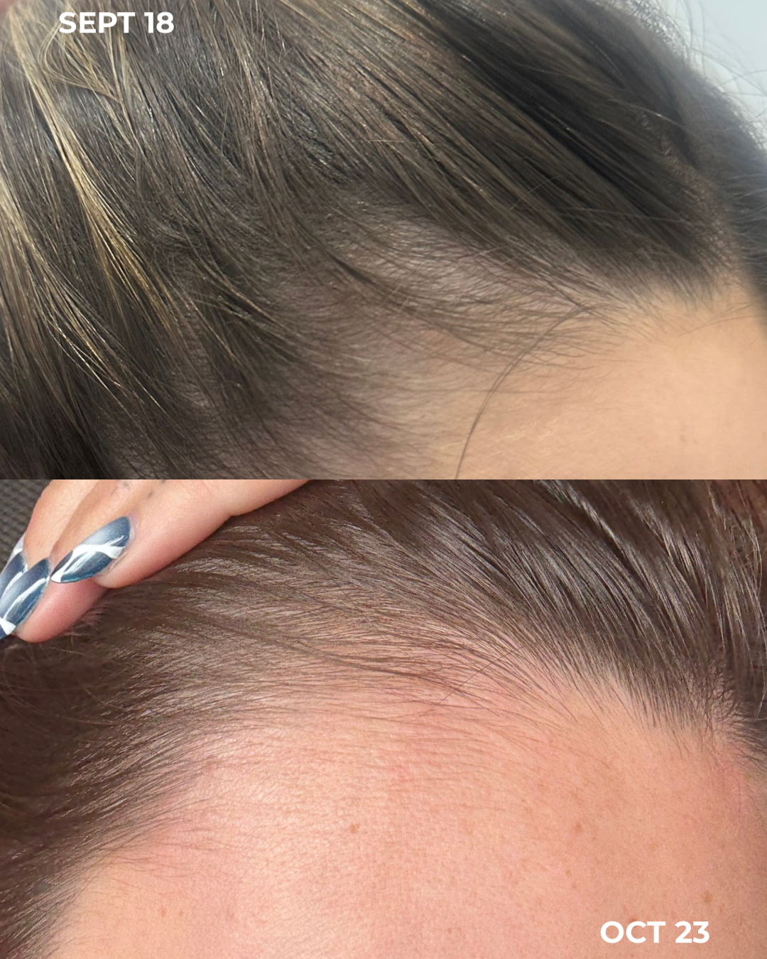 Hair Restoration with Exomide Exosomes