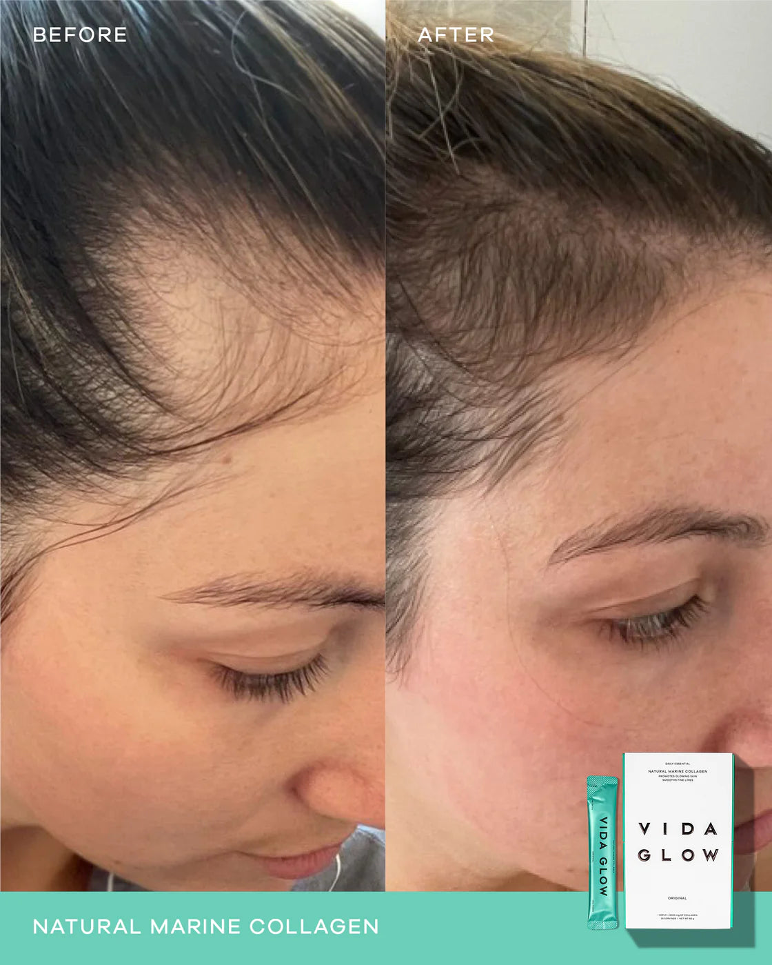 Before and after using Vida Glow Natural Marine Collagen Sachets Pineapple