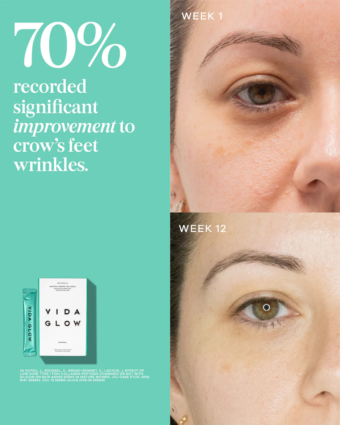 Significant Improvement of wrinkles using Vida Glow Natural Marine Collagen Sachets Mango