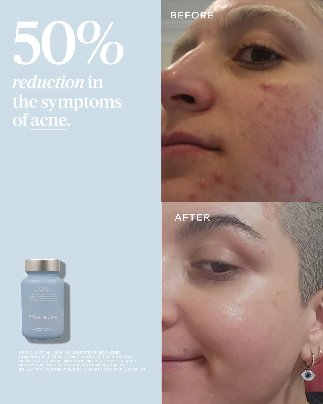 Before and After Using Vida Glow Clear Capsules