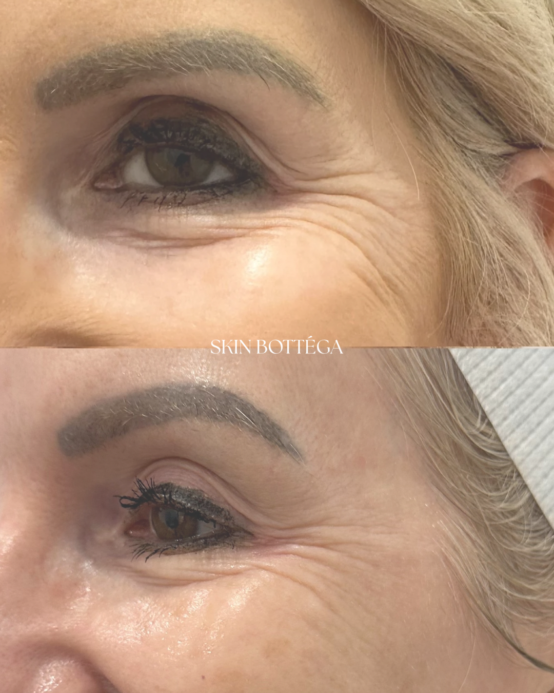 Rejuran - Salmon DNA Treatment - EOFY Edit