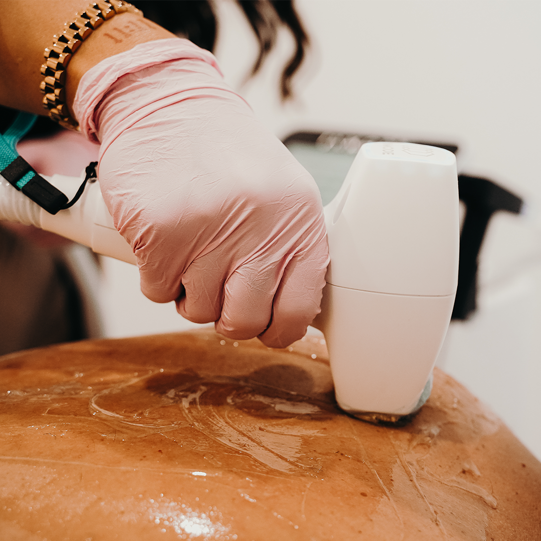 Laser Hair Reduction in Essendon, Melbourne