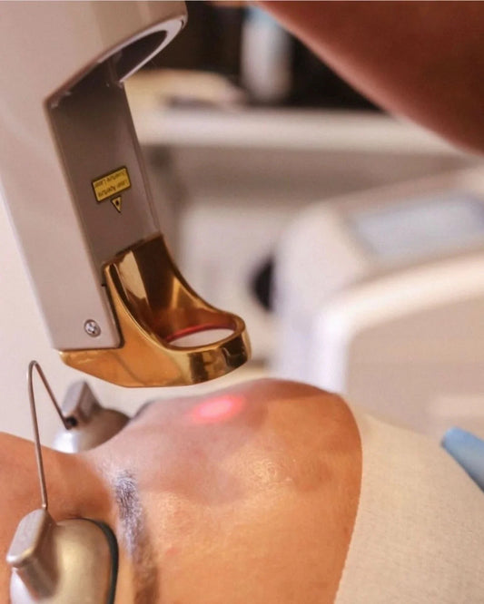 Practitioner performing Laser Genesis laser passes on patient's forehead