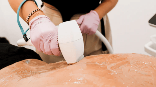 Laser Hair Removal in Melbourne