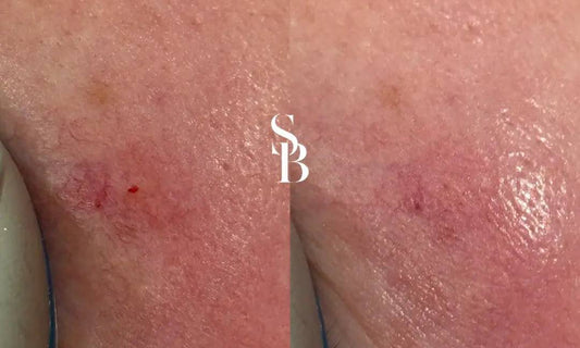 laser genesis before and after 