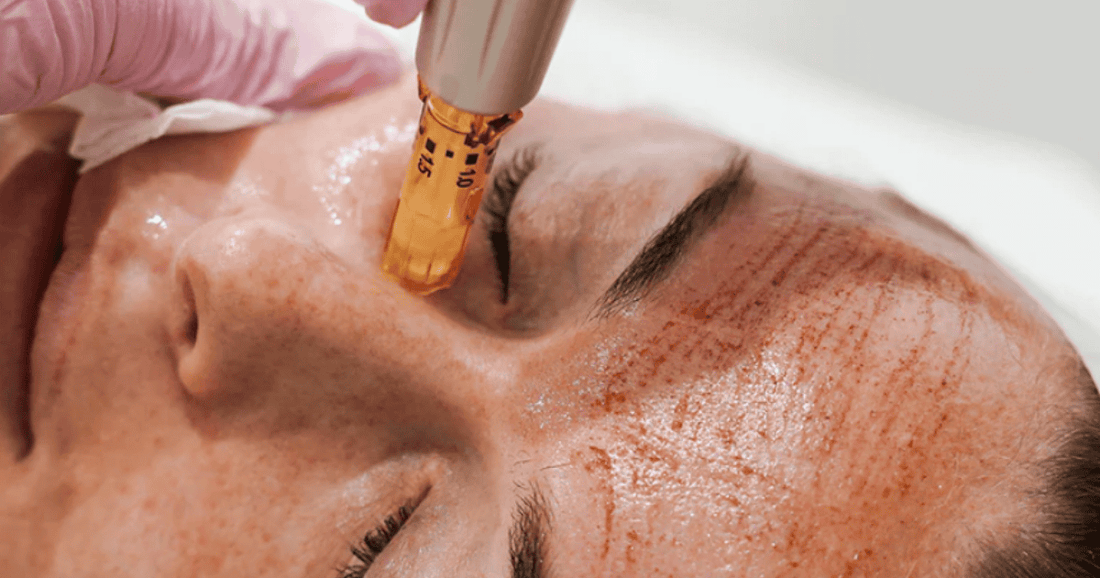 Skin Needling Treatment in Melbourne, Australia