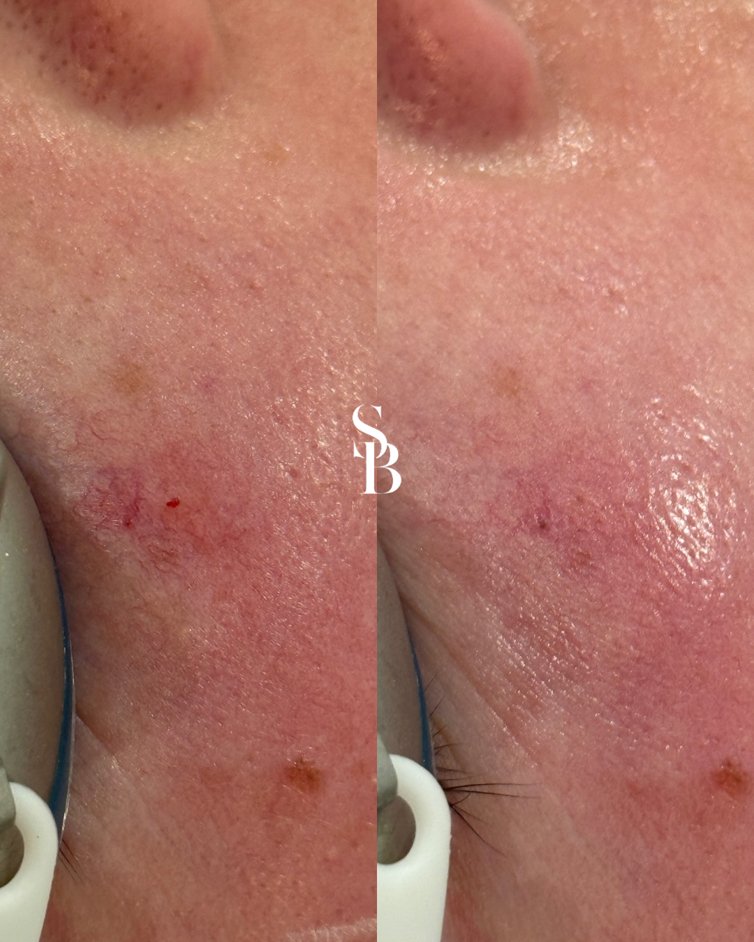 CoolView - Laser Treatment