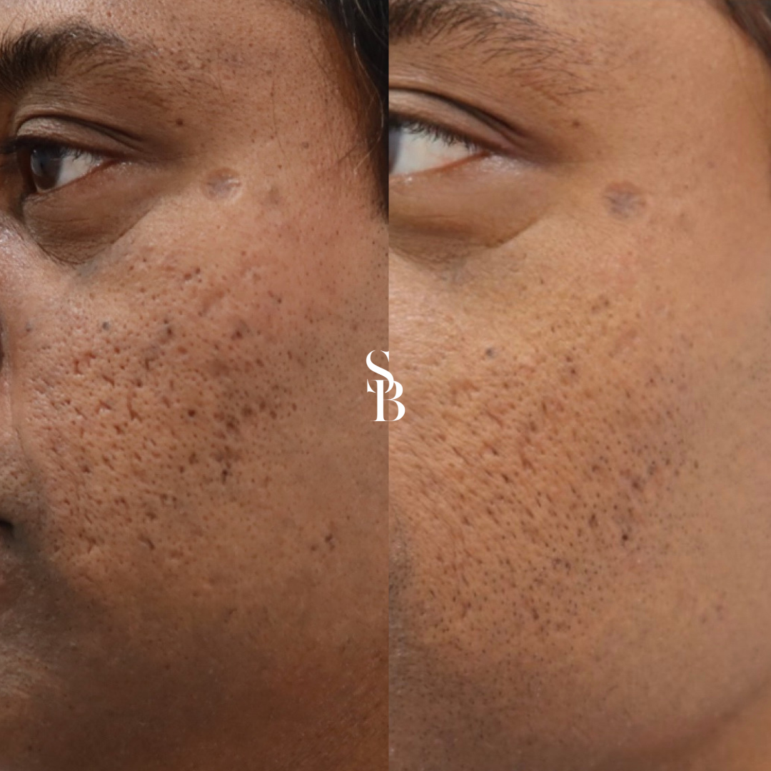 Morpheus8 Microneedling Melbourne – RF Skin Rejuvenation Support