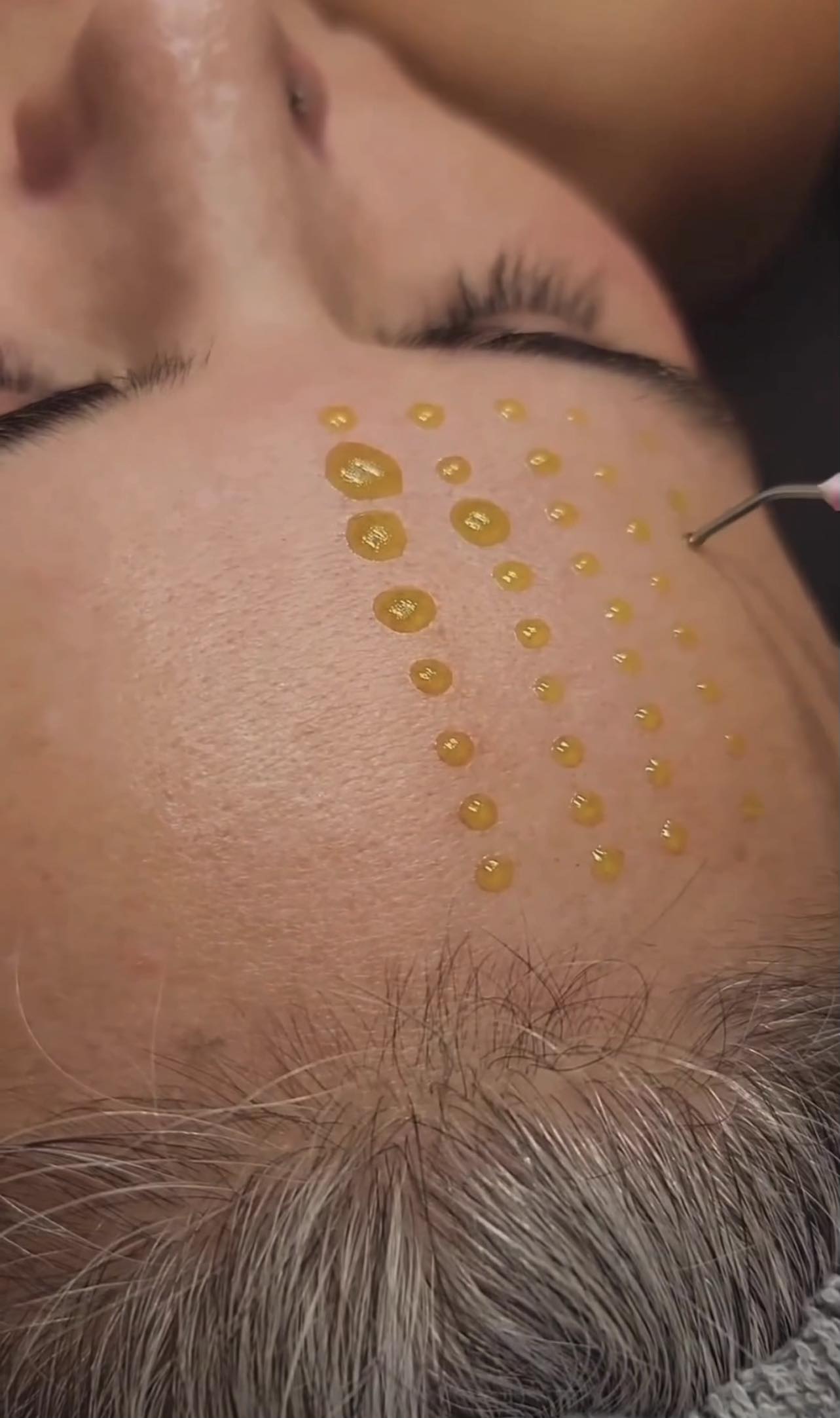 BioRePeel treatment in Essendon, Melbourne
