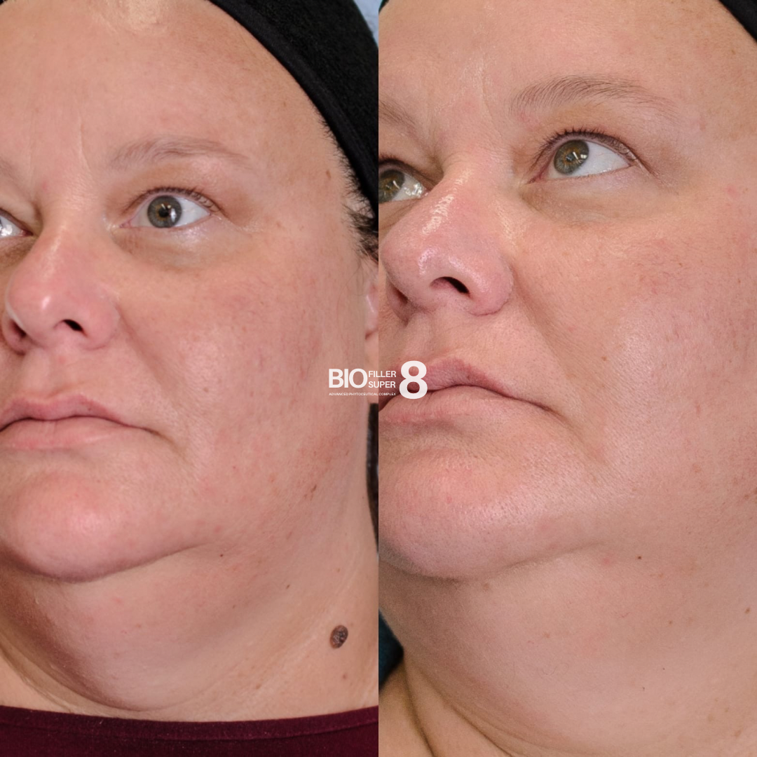 Biofiller Super8 Hydrating Facial - Insider Access Sale