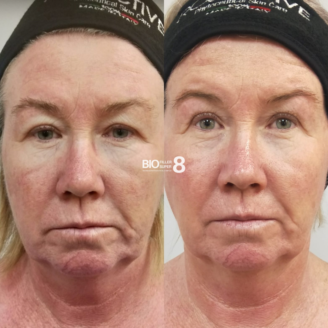 Biofiller Super8 Hydrating Facial - Insider Access Sale