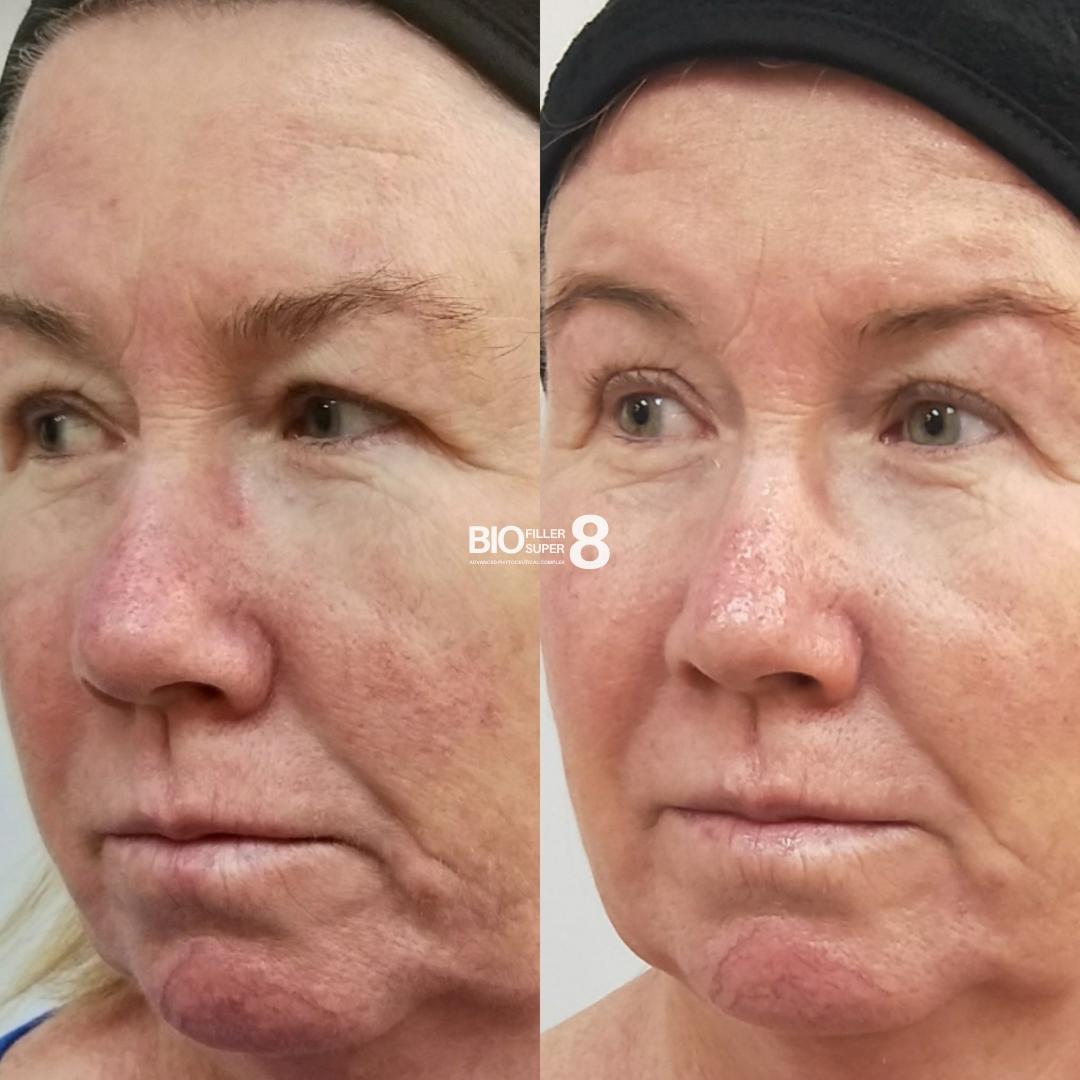 Biofiller Super8 Hydrating Facial - Insider Access Sale