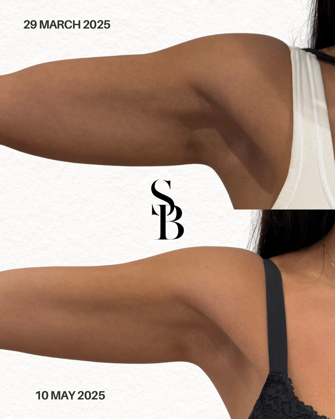 Morpheus8 Microneedling Melbourne – RF Skin Rejuvenation Support