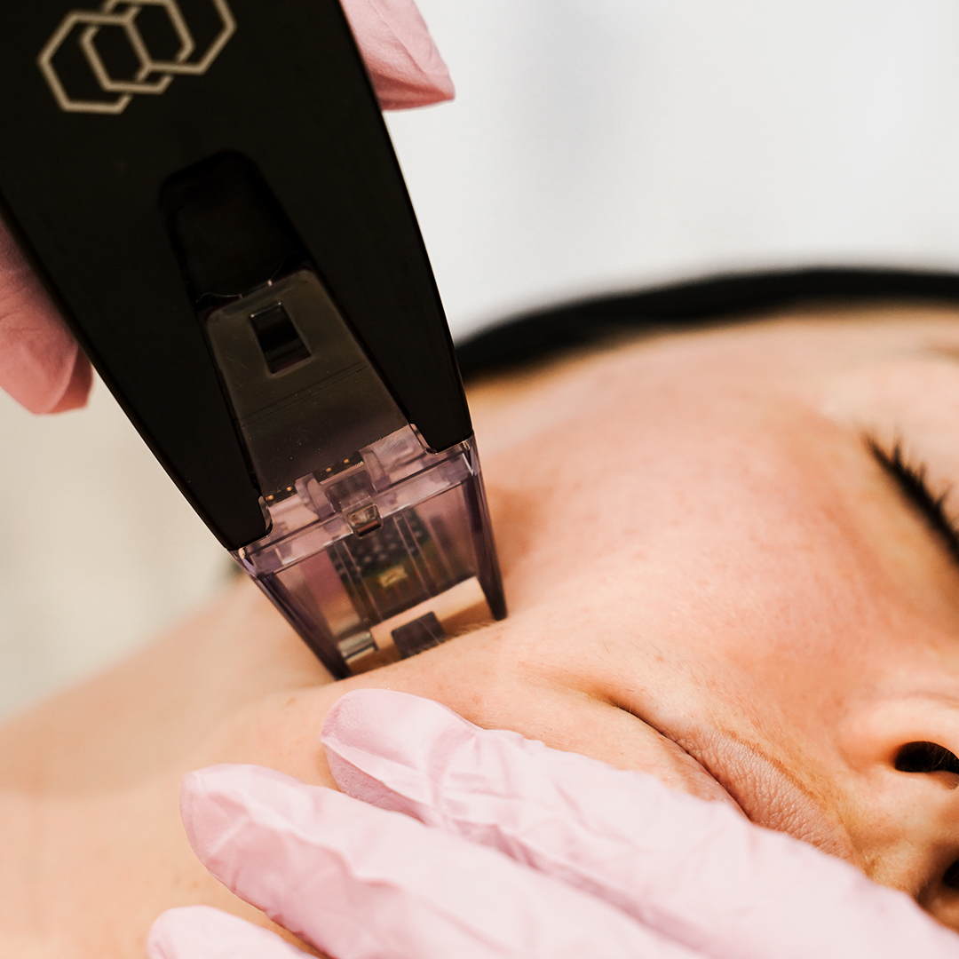 Morpheus8 Microneedling in Melbourne